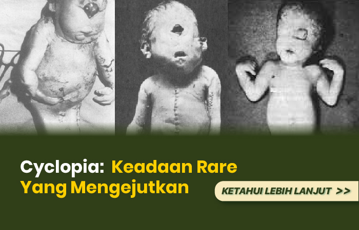 Cyclopia: Keadaan Rare yang Mengejutkan - OLIVE HOUSE HQ